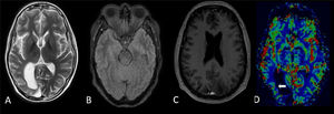 RM cerebral a las 4 semanas: en T2 axial (A), FLAIR (B) y T1 poscontraste (C), con una señal cortical T2 alta persistente muy sutil que afecta a la corteza temporal posterior, parietal y occipital derecha, pero con resolución de la mayor parte del realce cortical. En el mapa de perfusión (D), el hemisferio cerebral derecho presenta algunos focos persistentes sutiles de realce cortical con resolución del volumen sanguíneo cerebral, aumentado previamente (flecha blanca).