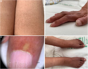 a) Presencia de hipertricosis. b) Acropaquia, acrocianosis y cambios esclerodermiformes en manos. c) Alteración en la dermatoscopia del lecho ungueal (presencia de espacios avasculares y disminución del número de capilares). d) Edema blando en MMII e hiperpigmentación.