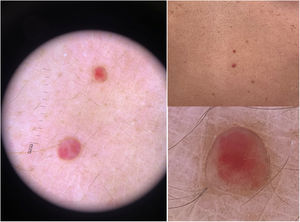 Hemangiomas glomerulares.