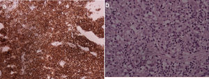 a)Hallazgos histopatológicos (infiltración linfocitaria de célulasB). b)Hallazgo en inmunohistoquímica: positividad para CD20. (Imágenes pertenecientes a la paciente.).