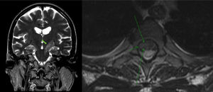 Izquierda: Corte coronal, secuencia T2/FLAIR. Se observa la extensión caudal de la lesión subtalámica izquierda hacia el pedúnculo cerebral ipsilateral. Derecha: Corte axial, secuencia T2. Se identifica una lesión focal intramedular a nivel dorsal alto.