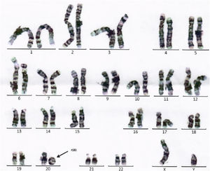 Cariotipo masculino con cromosoma 20 en anillo, de novo, confirmando mediante FISH pérdida de la región subtelomérica del brazo corto.