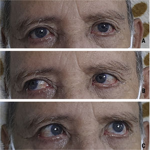A)Mirada primaria central. B)Mirada conjugada a la derecha. C)Mirada conjugada a la izquierda con limitación de la abducción del ojo izquierdo.