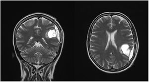 Resonancia magnética contrastada con gadobutrol; corte sagital (A) y transversal (B). Se aprecian en secuencia T2 contrastada cambios posquirúrgicos por resección de lesión en región parietal izquierda con craniectomía parietal ipsilateral y se observa realce paquimeníngeo adyacente al sitio quirúrgico, realce leptomeníngeo fino difuso, y prominencia de surcos y cisuras por pérdida de volumen del parénquima cerebral. Imagen tomada con resonador magnético de 1.5 Tesla. Fuente: Los autores.