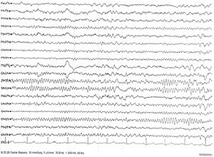 Registro electroencefalográfico en vigilia con ritmo alfa posterior y beta en regiones anteriores.