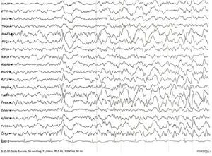 Registro electroencefalográfico en estadio N2 del sueño con presencia de ritmo delta intermitente frontal.