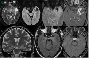 (A) T2 axial, DWI, GRE, T1FS post contrast. Solid-cystic mass lesion in left anterior temporal lobe with peripheral thick nodular enhancement and central necrotic area. Solid component of lesion showing few foci of haemorrhage within. Left mesial temporal lobe structures are infiltrated. (B) T2 oblique coronal, T2 FLAIR axial, T1FS post contrast. T2-FLAIR hyperintensity involving the bilateral mesial temporal lobes (L>R) with subtle enhancement in left amygdala and hippocampal head.
