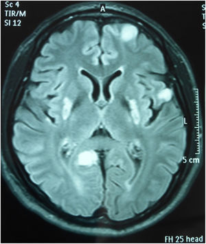 Resonancia magnética de encéfalo, secuencia FLAIR: hiperintensidades bilaterales simétricas en putámenes y en regiones corticales frontal y temporal derecho, y occipital izquierdo.