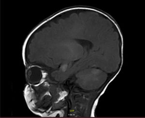 RNM de cerebro, T1 sin contraste, corte sagital: hiperintensidades cortico-subcorticales a nivel temporal medial, tálamo, algunos focos en corteza cerebelosa por melanosis.