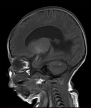 RNM cerebral simple y contrastada. En la secuencia de T1 se evidencia hiperintensidad en la amígdala, además foco hiperintenso yuxtacortical cerebeloso derecho. Ventriculomegalia supratentorial con ascenso y disminución del volumen del cuerpo calloso y medialización de las formaciones hipocampales.