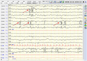 EEG de SNREM en el que se objetivan frecuentes paroxismos de puntas y punta-onda en regiones fronto-centro-temporales, asincrónicas, de predominio derecho.
