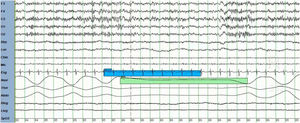 Paciente de sexo masculino de 65 años, presenta enfermedad neuromuscular, asociado a apneas durante el sueño, presenta un IAH centrales mayor a 5. Se evidencia en la imagen ausencia de flujo, acompañado de ausencia de esfuerzo toracoabdominal, compatible con una apnea central.