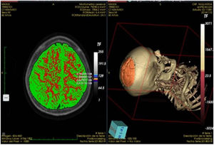 Presentación de la reconstrucción 3D del tejido encefálico en un corte tomográfico (p<0,005).