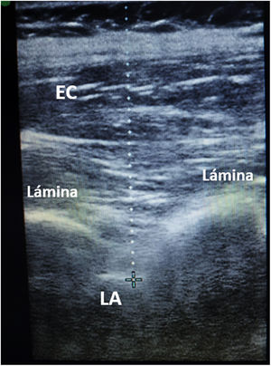 Medición de la profundidad del ligamento amarillo. El ligamento amarillo (LA) se visualiza mejor entre las láminas en un plano longitudinal y se puede medir la distancia entre este y la piel (línea vertical). EC: músculos erectores de la columna.
