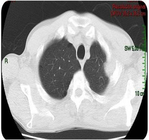 TC de tórax: adyacente al nódulo pulmonar, se visualiza formación con densidad de partes blandas que involucra la parrilla costal comprometiendo y engrosando la pleura con lisis del arco costal e irregularidad del mismo.