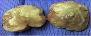 Pieza quirúrgica. Exéresis de lesión cerebral (absceso).