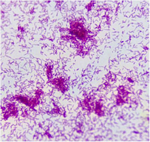 La figura de la izquierda muestra en el examen directo del material del absceso cerebral, con la coloración de ZN, abundantes BAAR. La figura de la derecha, muestra la tinción de ZN del cultivo del absceso con abundantes BAAR.