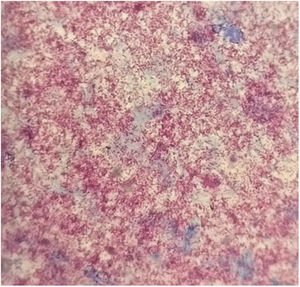 La figura de la izquierda muestra en el examen directo del material del absceso cerebral, con la coloración de ZN, abundantes BAAR. La figura de la derecha, muestra la tinción de ZN del cultivo del absceso con abundantes BAAR.