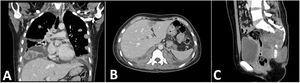Tomografía helicoidal multicorte. A) Tomografía de pulmones en corte coronal: múltiples nódulos sólidos pulmonares con necrosis central de distribución difusa en ambos campos pulmonares, algunos adosados a pleura, los de mayor tamaño se ubican en segmento anterior del lóbulo superior derecho que mide 26 mm de diámetro y base de lóbulo inferior izquierdo que mide 62 mm x 37 mm. Asociado a derrame pleural bilateral. B) Tomografía de abdomen en corte axial: nódulo sólido que muestra captación del medio de contraste, ubicado en segmento IVA, mide 18 mm x 17 mm. C) Tomografía de pelvis en corte sagital: proceso expansivo de aspecto lítico a nivel de S3 a S5 con extensión a partes blandas en forma de masa de bordes poco circunscritos que realza al medio de contraste mide 61 mm x 86 mm x 60 mm, aparenta infiltrar recto, con extensión a partes blandas.