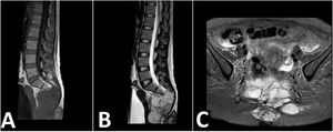 Resonancia magnética. A) Resonancia magnética sagital en T1: masa isointensa que se extiende por los agujeros sacros, mostrando apariencia multinodular. B) Resonancia magnética sagital en T2: masa hiperintensa de bordes lobulados que aparenta nacer del filum terminal y de la duramadre. C) Resonancia magnética en STIR, corte axial: la masa lobulada no suprime la señal, se muestra halo hipointenso marcado, masa adyacente a paredes de recto y de útero, sin signos de infiltración.