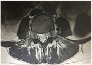 Resonancia magnética de columna dorsolumbar donde se documenta irregularidad en la intensidad de la señal del saco dural con realce anormal leptomeníngeo, con realce a nivel del origen de las raíces.