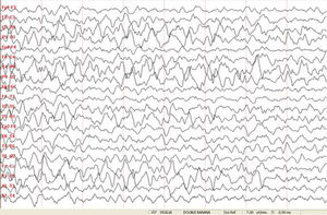 EEG de la paciente (junio de 2019).