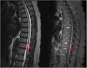 Transverse myelitis associated with autoimmune polyglandular syndrome ...