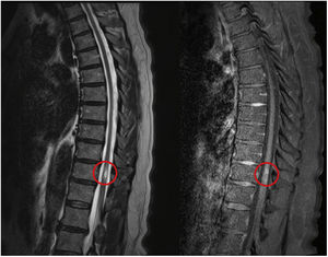 T2 and T1 weighted magnetic resonance imaging of the dorsal spine (sagittal slice) showing increased focal signal of central location, involving the distal dorsal medulla at D11 with central morphological involvement and contrast uptake suggesting progressive transverse myelitis.