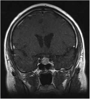 T1-weighted magnetic resonance imaging of the brain (coronal slice) showing a 14mm sellar lesion with low contrast uptake, optic chiasm preserving its usual signal, prominence of perivascular spaces in the basal ganglia and ventricular system and normal vascular structures.