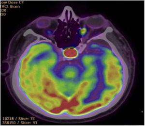 18F-FDG PET/CT of the brain showing hypermetabolic pituitary lesion slightly lateralized to the left with discrete contrast enhancement of 14mm with a SUVmax of 28.4.