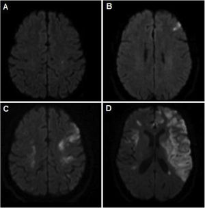 RM de cerebro (secuencia de difusión cerebral-DWI) que evidencia los diferentes eventos isquémicos presentados a lo largo de evolución de la enfermedad. A) Lesión puntiforme a nivel frontal izquierdo. B) Lesión a nivel prefrontal izquierdo. C) Lesiones isquémicas corticales en territorio de ambas arterias cerebrales medias. D) Extensas lesiones isquémicas a nivel del territorio carotídeo izquierdo y derecho.
