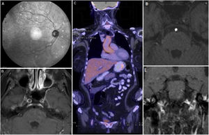 Hallazgos sistémicos. A) Fluoroscopia con focos de coroiditis. B) RM cerebro con contraste que evidencia captación de la pared de ambas carótidas internas asociado a ausencia de flujo de las mismas. C) PET con evidencia de captación de FDG a nivel aórtico y femoral derecho. D) AngioRM de cerebro donde se observa ausencia de relleno de ambas carótidas internas. E) RM de conductos auditivos internos con contraste EV, se menciona captación de contraste de ambos laberintos (a predominio izquierdo), compatible con laberintitis.