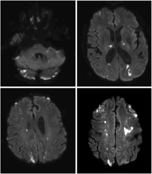 Resonancia de cerebro sin contraste, secuencia DWI. Se observan múltiples lesiones hiperintensas que afectan al territorio limítrofe comprometiendo ambos hemisferios cerebrales. A nivel supratentorial se observan múltiples lesiones que afectan tálamos, territorio limítrofe entre arterias cerebral media y anterior en la corona radiata y centros semiovales compatibles con lesiones isquémicas en estadio agudo e hiperagudo.