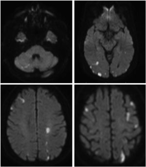 Resonancia de cerebro sin contraste, secuencia DWI. Se observan múltiples lesiones hiperintensas que afectan el territorio limítrofe de ambos hemisferios cerebrales ubicadas en regiones supra e infratentorial.