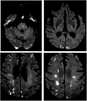 Resonancia de cerebro sin contraste con secuencia DWI. Se observan múltiples lesiones corticales y subcorticales con restricción de la difusión, supra e infratentoriales en ambos hemisferios cerebrales de distribución en territorios limítrofes.