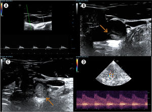 A) Estudio carotídeo (modo dúplex, plano sagital): flujo preoclusivo y «flap» intimal. B) Estudio carotídeo (modo brillo, plano axial): «flap» intimal. C) Estudio carotídeo (modo brillo, plano axial): oclusión carotídea por trombo impactado. D) Estudio transcraneal (plano axial): Acom con incremento de flujo y soplo sistólico.