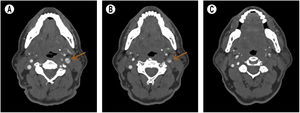 A) Signo de «doble luz» (corte axial). B) Hematoma mural y signo de «media luna» (corte axial). C) Oclusión carotídea (corte axial).