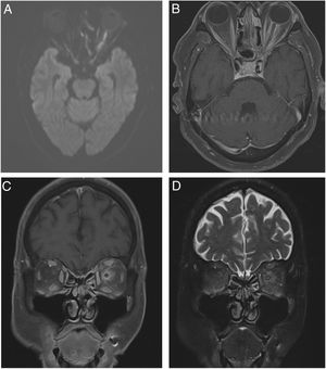 RM cerebral contrastada. A) Secuencia DWI corte axial: se evidencia hiperintensidad en la secuencia de difusión de todo el segmento intraorbitario del nervio óptico izquierdo. B) Secuencia T1 con supresión grasa corte axial: se evidencia perineuritis de nervio óptico izquierdo. C) Secuencia T1 con supresión grasa corte coronal: se evidencia perineuritis nervio óptico izquierdo con hiperintensidad en grasa intraconal y músculos extraoculares. D) Secuencia T2 corte coronal: se evidencia perineuritis y cambios inflamatorios en la grasa intraconal y músculos extraoculares.