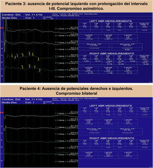 Potenciales auditivos con compromiso periférico de la vía auditiva.