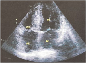 Ecocardiograma transtorácico.