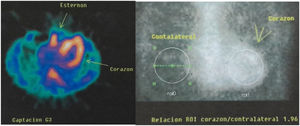 Spect cardiaco con pirofosfato de tecnecio.