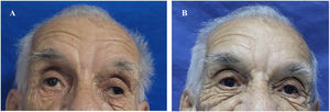 La fotografía A fue tomada antes de iniciar terapia con plasmaféresis. Se realizó exploración de movimientos extraoculares evidenciando ausencia de la mirada conjugada horizontal y vertical. Observamos mirada fija con estrabismo divergente de predominio izquierdo y ptosis palpebral bilateral. La fotografía B fue tomada posterior a cinco sesiones de plasmaféresis. Se obtuvo mejoría del estrabismo y de la parálisis facial, pero con persistencia leve de la parálisis de los músculos extraoculares.