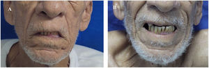 En la fotografía A, tomada antes de la terapia con plasmaféresis, se observa disminución del surco nasogeniano izquierdo por una parálisis periférica facial. La fotografía B, tomada después de cinco sesiones de plasmaféresis, muestra resolución completa de la parálisis facial.