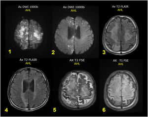 Resonancia magnética cerebral simple. Múltiples focos isquémicos subagudos coalescentes corticosubcorticales frontales altos bilaterales y parietales mediales derechos con aumento del tamaño del sistema ventricular supratentorial y ensanchamiento de los espacios subaracnoideos para las convexidades, compensatorios.