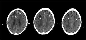 Tomografía de cráneo simple. Imágenes hipodensas serpingiformes corticales frontales anteriores bilaterales (flechas blancas) altamente sugestivas de embolismo graso, foco malácico secuelar occipital derecho, leucoencefalopatía microangiopática.