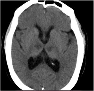 TC Encéfalo sin contraste. Incidencia axial. Hipodensidad a nivel talámico en región ventromedial bilateral.