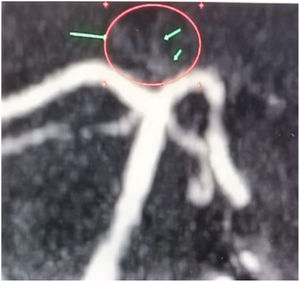 Angiotomografía de encéfalo. Incidencia coronal. Variante 2b de arteria talámica paramediana: arteria de Percheron.