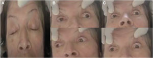 Evaluación oculomotora de la paciente al egreso. A) Ptosis bilateral. B) Oftalmoplejía internuclear bilateral. C) Plejía a la mirada vertical.