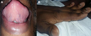 A) Telangiectasia en dorso de lengua. B) Acropaquias.