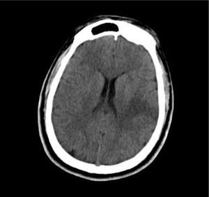 Tomografía de encéfalo. Hipodensidad corticosubcortical en el lóbulo de ínsula, temporal posterior y tálamo izquierdos. Fuente: Hospital Nacional Edgardo Rebagliati Martins, Servicio de Imagenología.